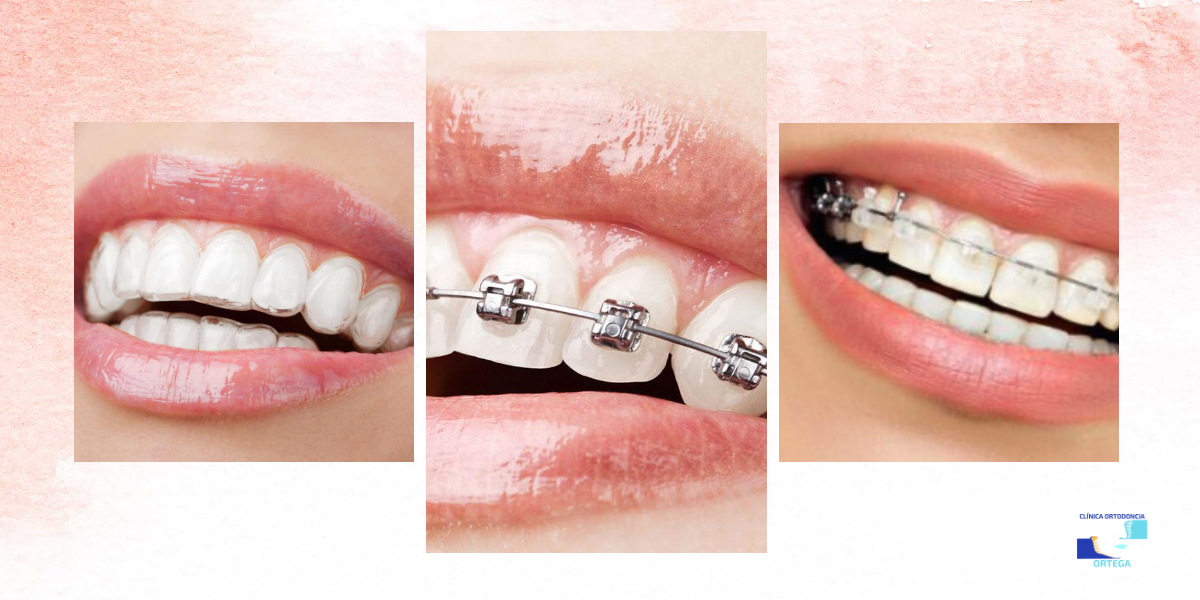 Que Tipos De Brackets Existen Y Cuales Son Sus Diferencias Clinica Images 6433